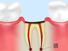 歯の根を切る「歯根端切除術」で治療します
