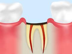 歯の根を切る「歯根端切除術」で治療します